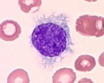 Волосатоклеточный лейкоз