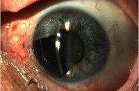 Меланома глаза