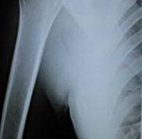 Процедура Рентген плечевой кости