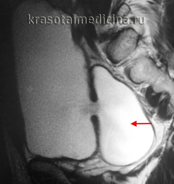 МРТ таза. Дивертикул задней стенки мочевого пузыря