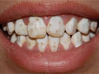 Некариозные поражения зубов 