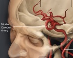 Синдром средней мозговой артерии