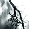 Эмболизация ветвей внутренней подвздошной артерии