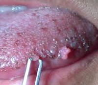 Папилломы полости рта