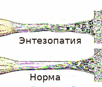 Enthesopathie