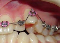Дистопированный зуб
