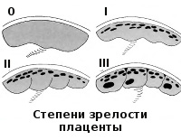 Преждевременное созревание плаценты