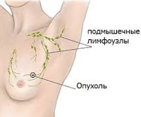 Трижды негативный рак молочной железы