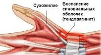 Тендовагинит кисти