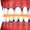Восстановление режущего края зуба