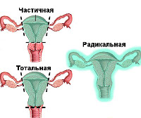 Процедура Гистерэктомия