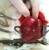 Удаление опухоли сердца