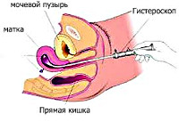 Процедура Гистероскопия