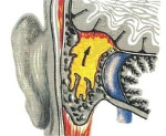 Отогенные внутричерепные осложнения
