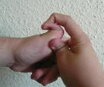 Ehlers-Danlos-Syndrom