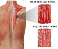 От чего происходит воспаление мышцы thumbnail
