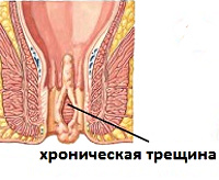 Хроническая анальная трещина