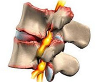 liječenje osteoartritisa i spondiloze)