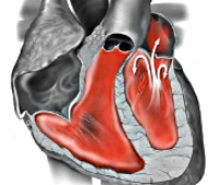Комбинированный митральный порок сердца