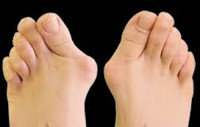 Hallux valgus