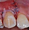 Снятие швов в стоматологии