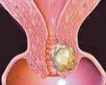 Рецидив рака шейки матки
