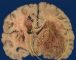 Диета при опухоли головного мозга глиобластома