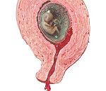 Самопроизвольный аборт: угроза прерывания беременности на ранних сроках