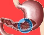 Гастроеюнальная язва Гастроеюнальная язва