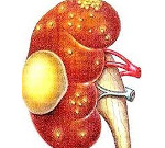 Карбункул почки