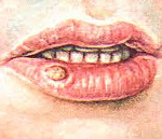 Кератоакантома губ и слизистой рта