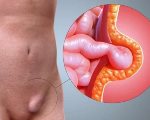 Ущемленная паховая грыжа у детей Ущемленная паховая грыжа у детей