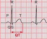 Синдром удлиненного интервала QT