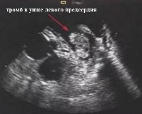 Внутрисердечный тромбоз