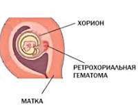 Гематома При Беременности Фото