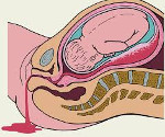Кровотечение при беременности