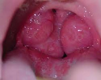 Гипертрофия нёбных миндалин