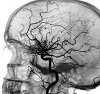 Ангиография головного мозга