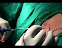 Процедура Нефроскопия (пиелоскопия)