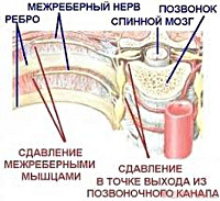 Межреберная невралгия