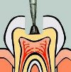 Формирование кариозной полости