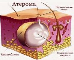 Атерома