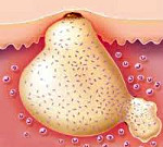 Абсцесс кожи