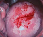 Эритроплакия шейки матки