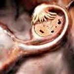 Синдром истощенных яичников при климаксе