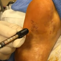 Пяточную шпору предложено лечить инъекциями аутожира Пяточную шпору предложено лечить инъекциями аутожира