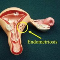 Боль при эндометриозе можно уменьшить с помощью ботокса