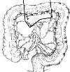 Резекция поперечно-ободочной кишки
