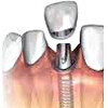 Временная коронка на имплант