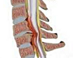 Компрессионная миелопатия